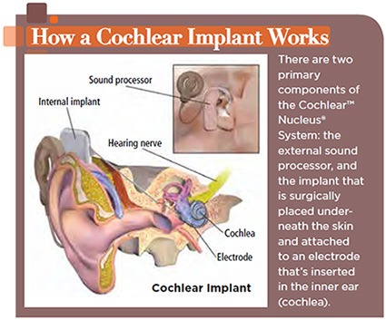 medical drawing of a cochlear implant in the ear