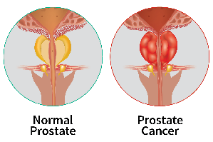 Image of healthy prostate versus one with cancer