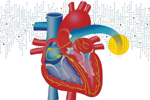 Heart failures patients live more comfortably at home thanks to remote monitoring.