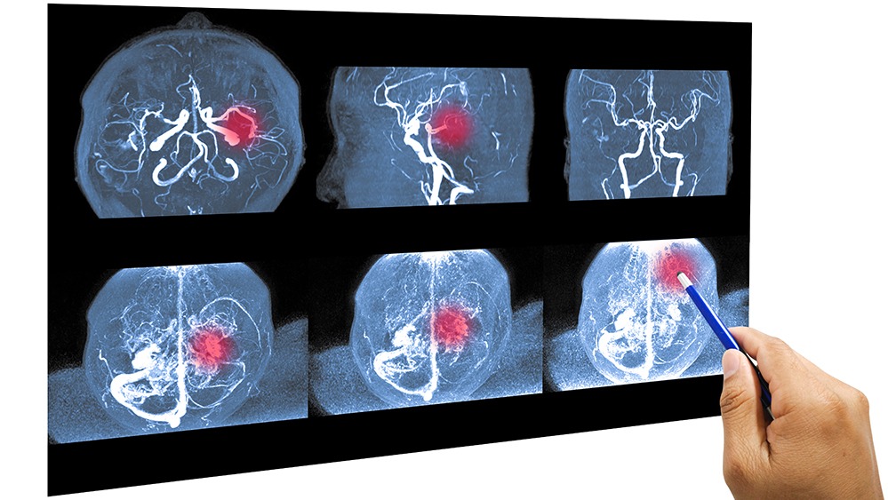 Understanding Brain Aneurysms: Causes, Symptoms, and Lifesaving Treatments